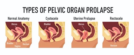 What is prolapse? — SheSpot