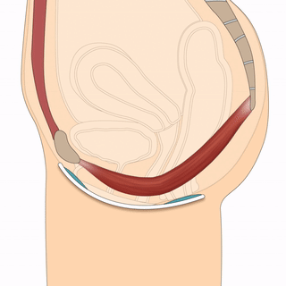 Elitone contracting pelvic floor muscles